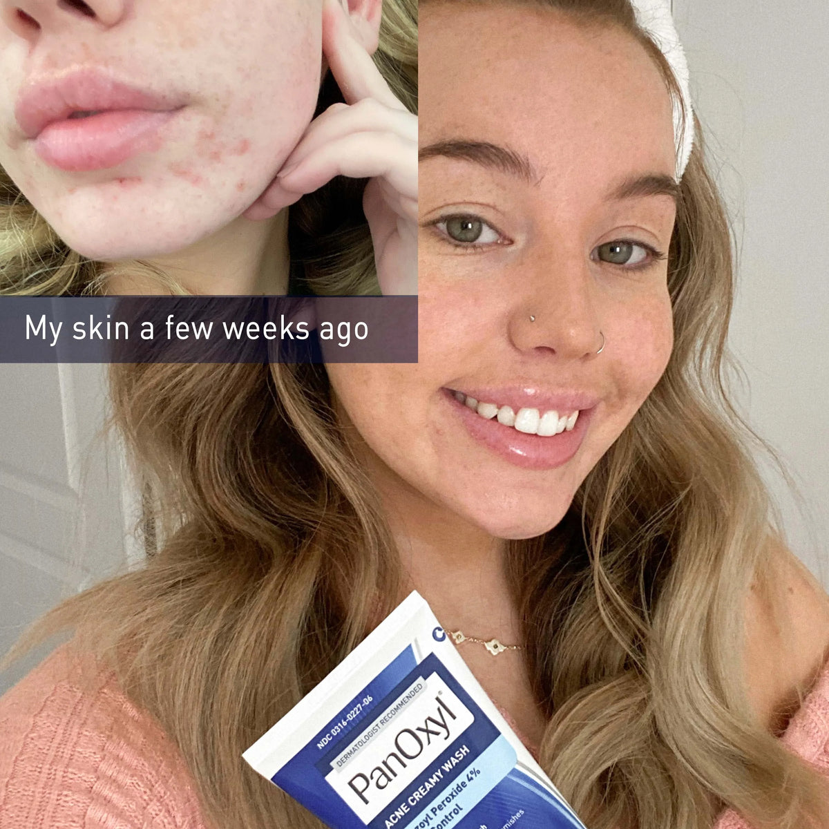 4% Benzoyl Peroxide Acne Creamy Wash L957
